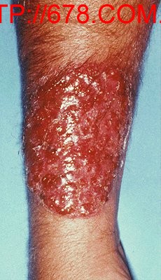 Bệnh nấm da